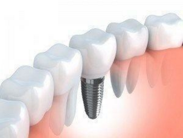 dental implant